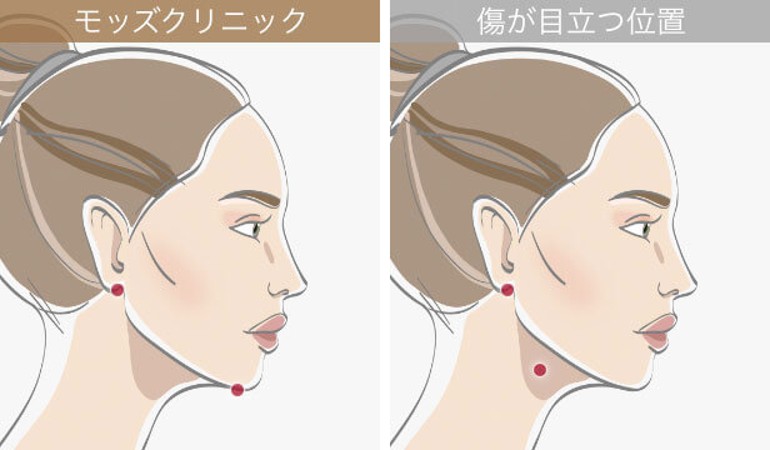 フェイスラインの傷跡位置比較