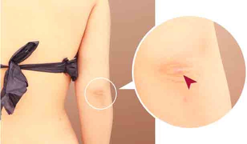 傷跡の位置への配慮イメージ