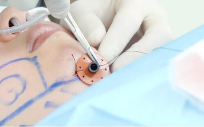 スキンポートの使用イメージ