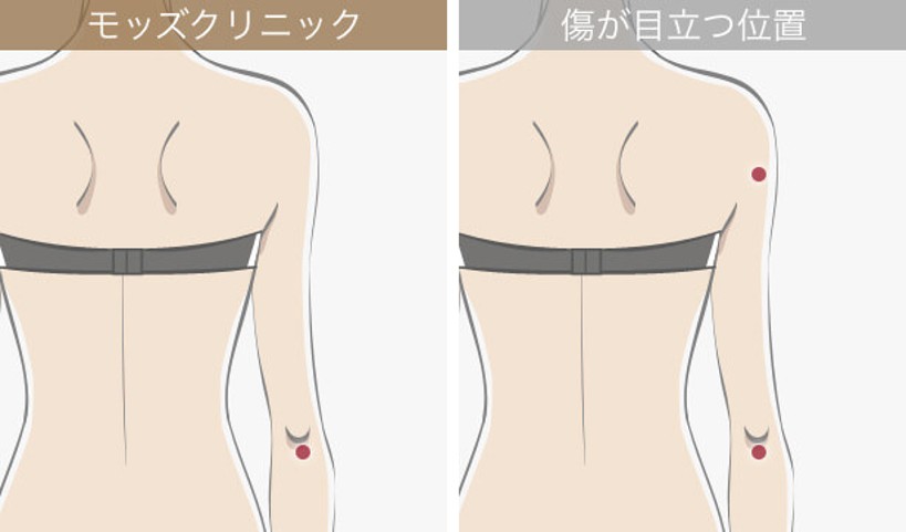 背中側の傷跡位置比較